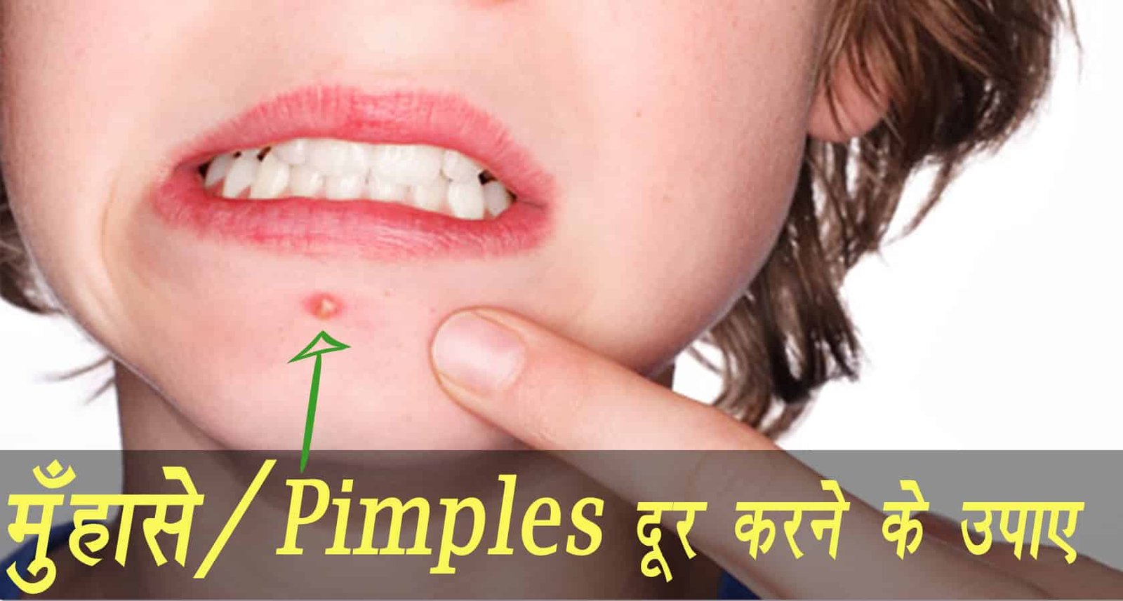 pimples and acne home remedies